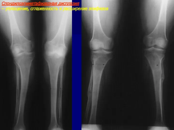 Спондилоэпиметафизарная дисплазия – уплощение, сглаженность и расширение эпифизов
