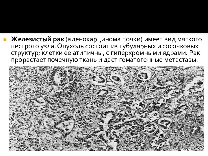 Железистый рак (аденокарцинома почки) имеет вид мягкого пестрого узла. Опухоль