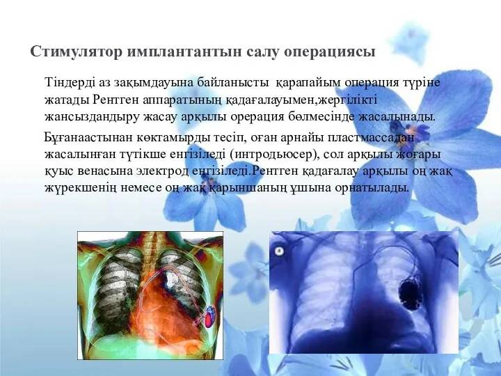 Стимулятор имплантантын салу операциясы Тіндерді аз зақымдауына байланысты қарапайым операция