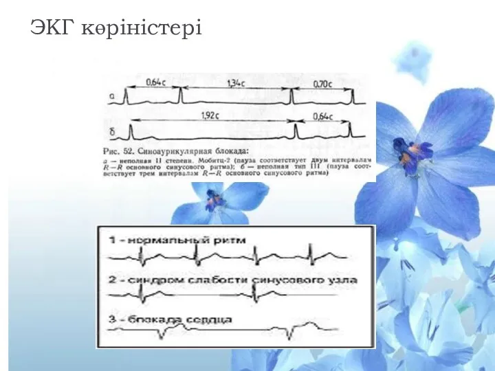 ЭКГ көріністері