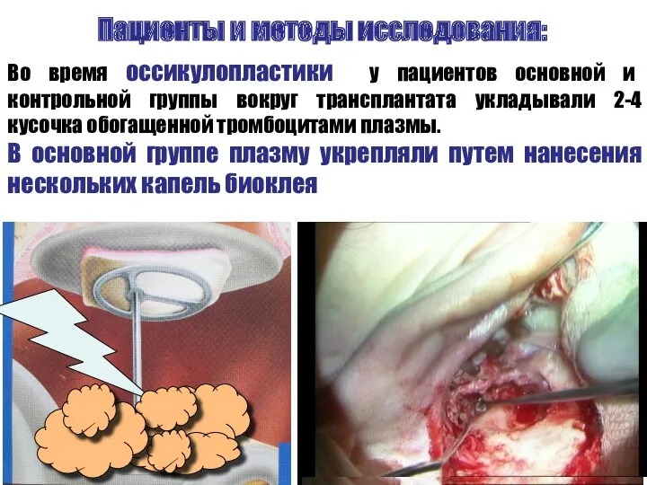 Пациенты и методы исследования: Во время оссикулопластики у пациентов основной