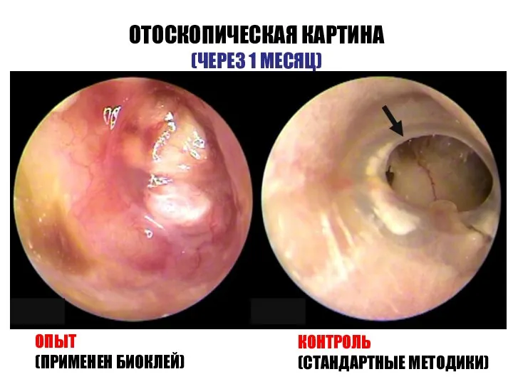 ОТОСКОПИЧЕСКАЯ КАРТИНА (ЧЕРЕЗ 1 МЕСЯЦ) ОПЫТ (ПРИМЕНЕН БИОКЛЕЙ) КОНТРОЛЬ (СТАНДАРТНЫЕ МЕТОДИКИ)