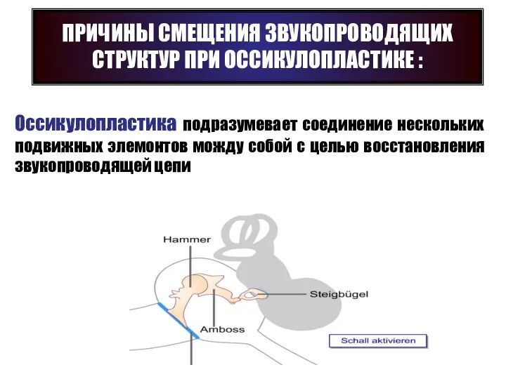 Оссикулопластика подразумевает соединение нескольких подвижных элемонтов можду собой с целью