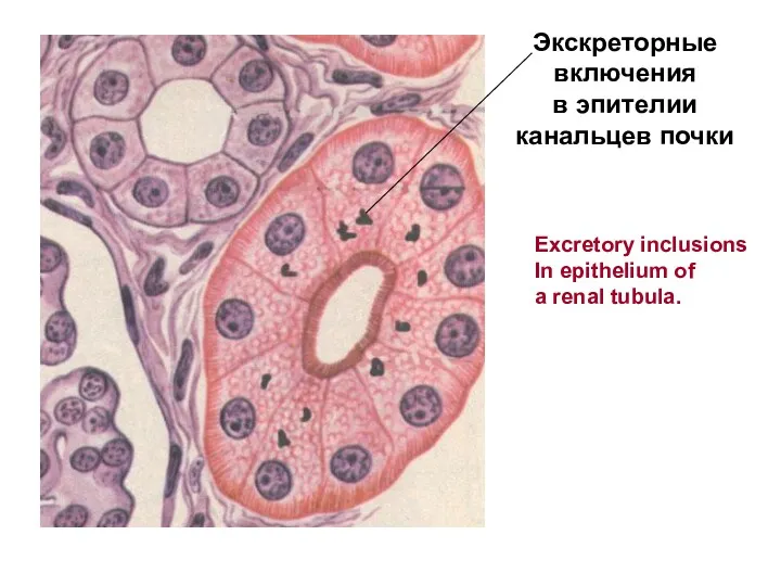 Экскреторные включения в эпителии канальцев почки Excretory inclusions In epithelium of a renal tubula.