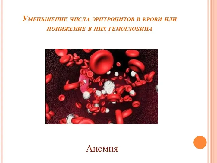 Уменьшение числа эритроцитов в крови или понижение в них гемоглобина Анемия