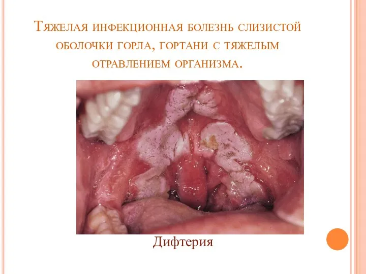 Тяжелая инфекционная болезнь слизистой оболочки горла, гортани с тяжелым отравлением организма. Дифтерия