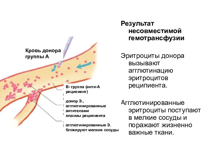 Результат несовместимой гемотрансфузии Эритроциты донора вызывают агглютинацию эритроцитов реципиента. Агглютинированные