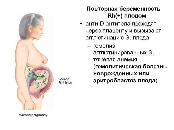 Повторная беременность Rh(+) плодом анти-D антитела проходят через плаценту и