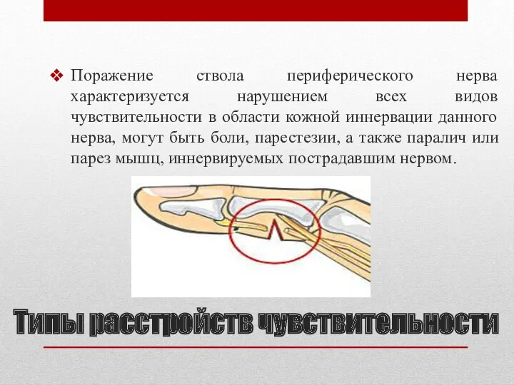 Типы расстройств чувствительности Поражение ствола периферического нерва характеризуется нарушением всех