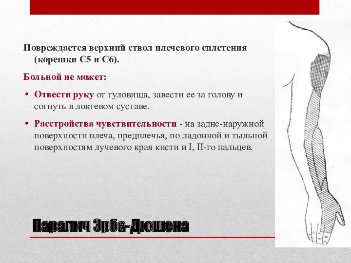 Паралич Эрба-Дюшена Повреждается верхний ствол плечевого сплетения (корешки С5 и