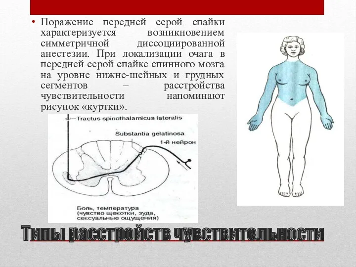 Поражение передней серой спайки характеризуется возникновением симметричной диссоциированной анестезии. При