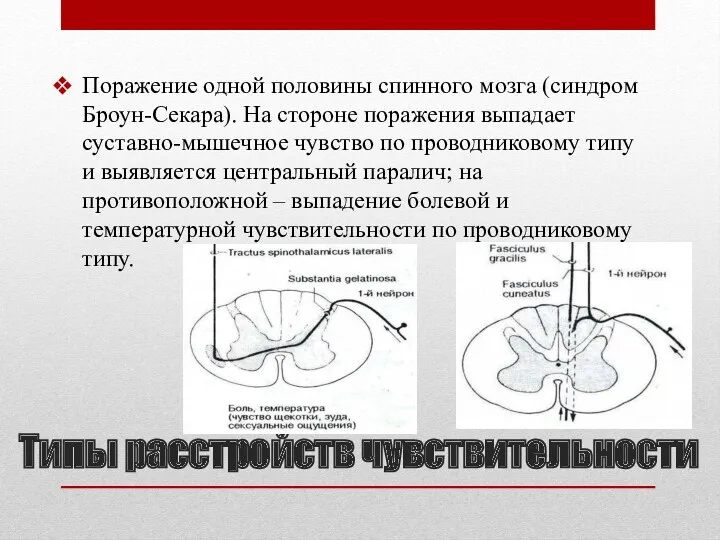 Поражение одной половины спинного мозга (синдром Броун-Секара). На стороне поражения