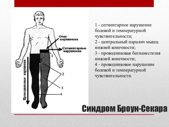 1 - сегментарное нарушение болевой и темпе­ратурной чувствительности; 2 -