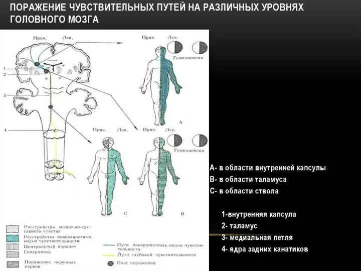 Типы расстройств чувствительности