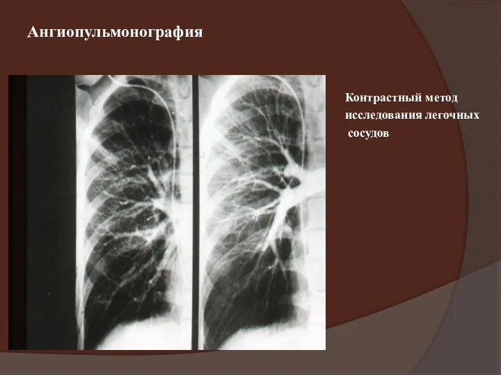 Ангиопульмонография Контрастный метод исследования легочных сосудов