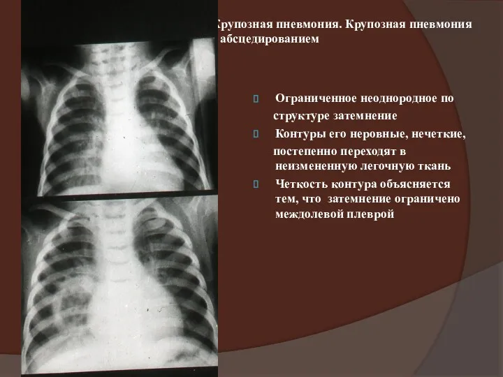 Крупозная пневмония. Крупозная пневмония с абсцедированием Ограниченное неоднородное по структуре