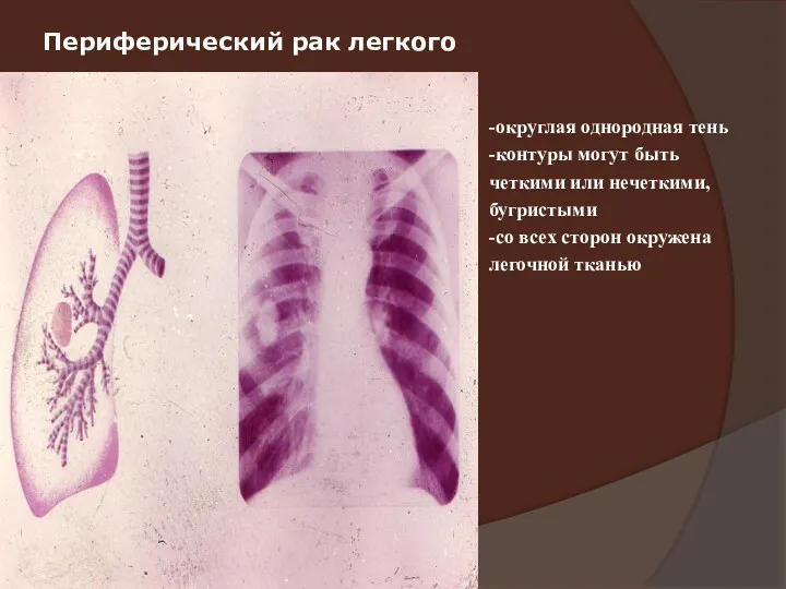 Периферический рак легкого -округлая однородная тень -контуры могут быть четкими