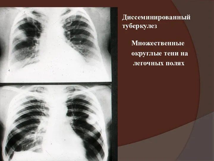 Диссеминированный туберкулез Множественные округлые тени на легочных полях