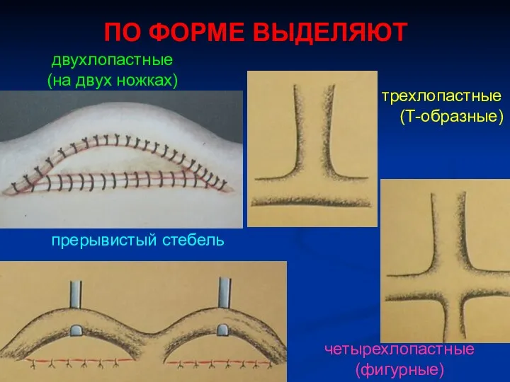 ПО ФОРМЕ ВЫДЕЛЯЮТ двухлопастные (на двух ножках) трехлопастные (Т-образные) прерывистый стебель четырехлопастные (фигурные)