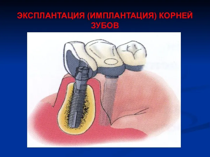 ЭКСПЛАНТАЦИЯ (ИМПЛАНТАЦИЯ) КОРНЕЙ ЗУБОВ