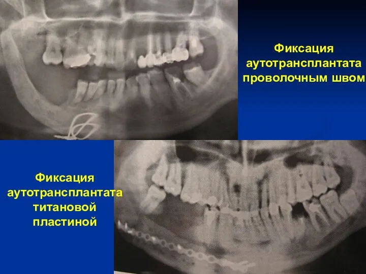 Фиксация аутотрансплантата проволочным швом Фиксация аутотрансплантата титановой пластиной