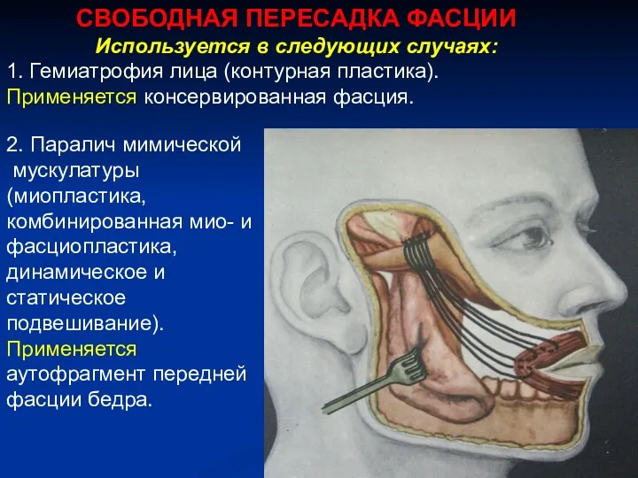 СВОБОДНАЯ ПЕРЕСАДКА ФАСЦИИ Используется в следующих случаях: 1. Гемиатрофия лица