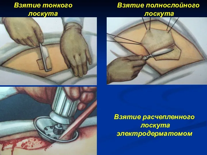 Взятие тонкого лоскута Взятие полнослойного лоскута Взятие расчепленного лоскута электродерматомом