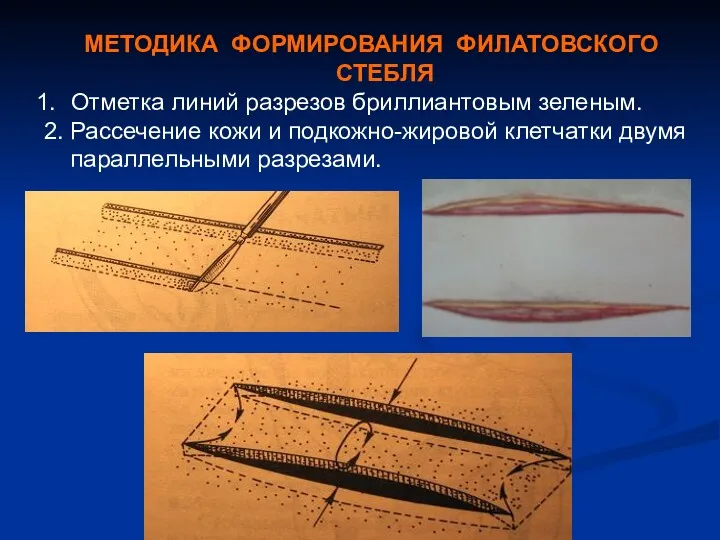 МЕТОДИКА ФОРМИРОВАНИЯ ФИЛАТОВСКОГО СТЕБЛЯ Отметка линий разрезов бриллиантовым зеленым. 2.