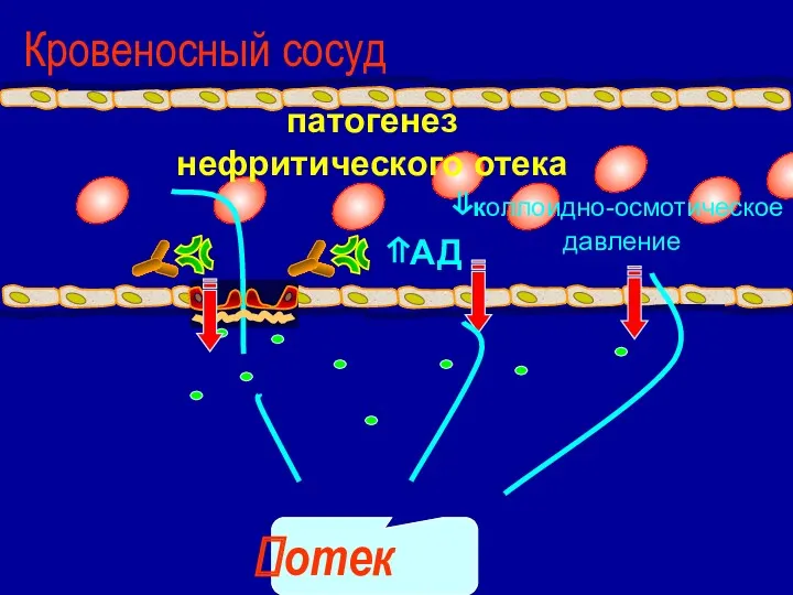 ⇑АД отек ⇓коллоидно-осмотическое давление патогенез нефритического отека Кровеносный сосуд