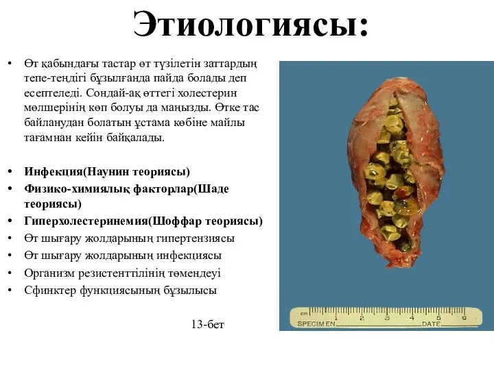 Этиологиясы: Өт қабындағы тастар өт түзілетін заттардың тепе-теңдігі бұзылғанда пайда