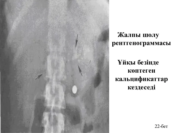 Жалпы шолу рентгенограммасы Ұйқы безінде көптеген кальцификаттар кездеседі 22-бет