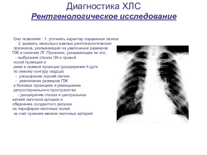 Диагностика ХЛС Рентгенологическое исследование Оно позволяет : 1. уточнить характер