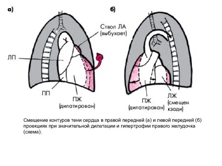 Смещение контуров тени сердца в правой передней (а) и левой