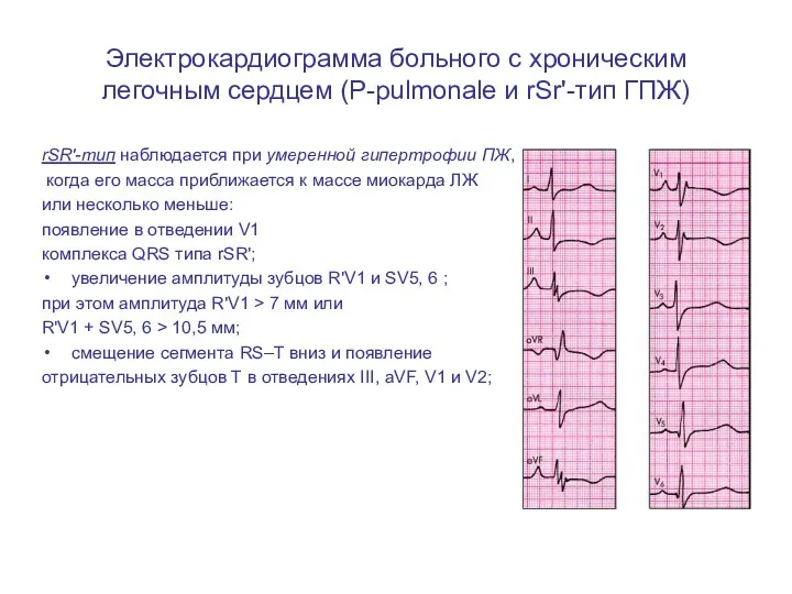 Электрокардиограмма больного с хроническим легочным сердцем (Р-pulmonale и rSr'-тип ГПЖ)
