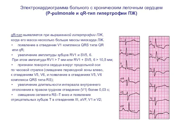 Электрокардиограмма больного с хроническим легочным сердцем (Р-pulmonale и qR-тип гипертрофии