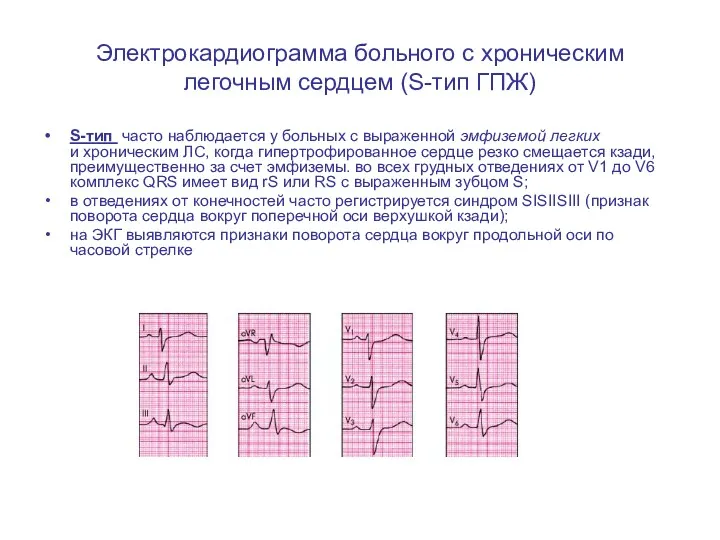 Электрокардиограмма больного с хроническим легочным сердцем (S-тип ГПЖ) S-тип часто