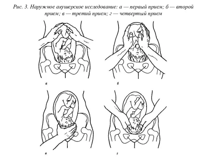 Рис. 3. Наружное акушерское исследование: а — первый прием; б