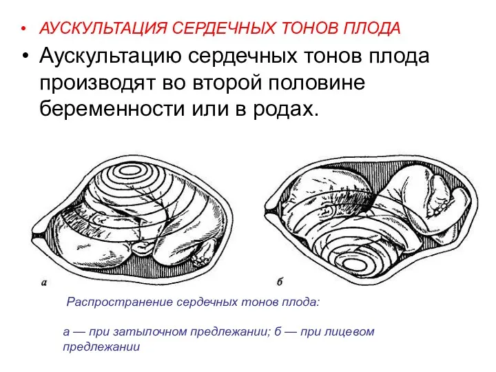 АУСКУЛЬТАЦИЯ СЕРДЕЧНЫХ ТОНОВ ПЛОДА Аускультацию сердечных тонов плода производят во