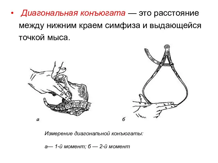 Диагональная конъюгата — это расстояние между нижним краем симфиза и