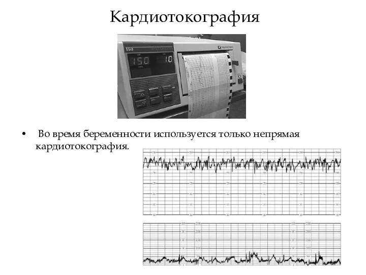 Кардиотокография Во время беременности используется только непрямая кардиотокография.