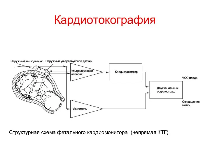 Кардиотокография Структурная схема фетального кардиомонитора (непрямая КТГ)