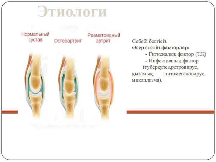 Этиология Себебі белгісіз. Әсер ететін факторлар: - Гигиеналық фактор (Т.Қ)