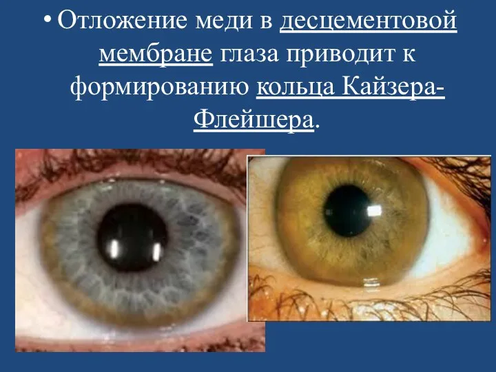 Отложение меди в десцементовой мембране глаза приводит к формированию кольца Кайзера-Флейшера.