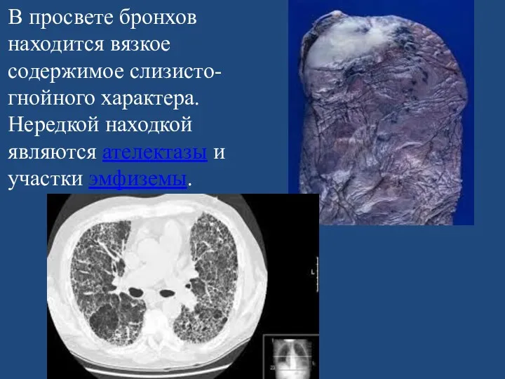 В просвете бронхов находится вязкое содержимое слизисто-гнойного характера. Нередкой находкой являются ателектазы и участки эмфиземы.
