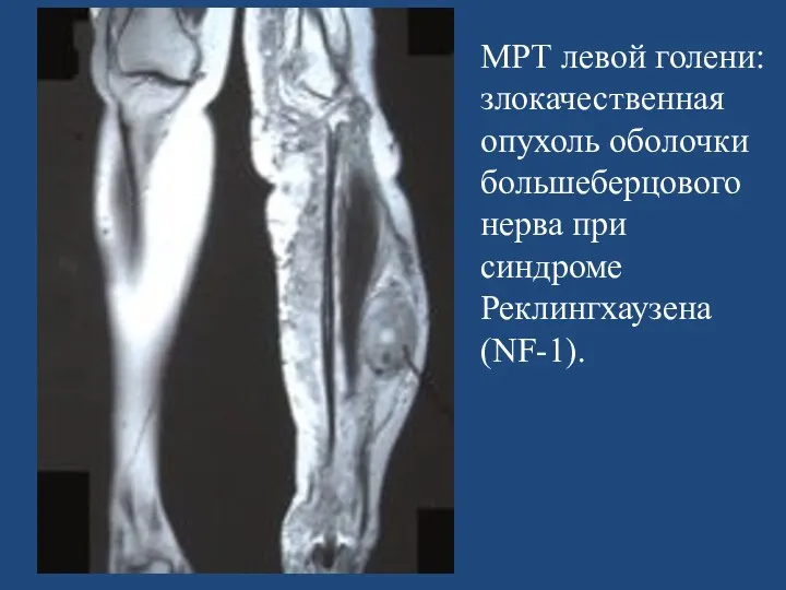 МРТ левой голени: злокачественная опухоль оболочки большеберцового нерва при синдроме Реклингхаузена (NF-1).