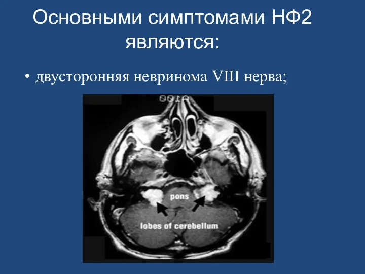 Основными симптомами НФ2 являются: двусторонняя невринома VIII нерва;