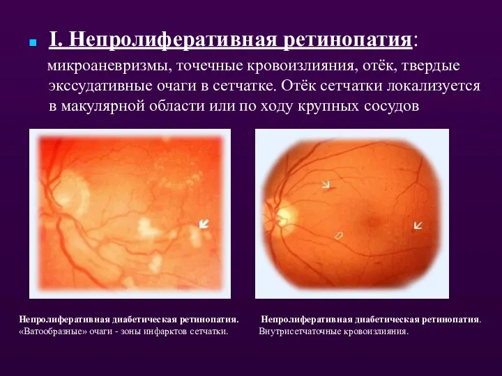 I. Непролиферативная ретинопатия: микроаневризмы, точечные кровоизлияния, отёк, твердые экссудативные очаги