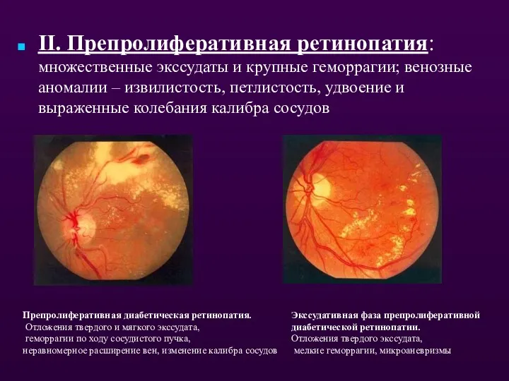 II. Препролиферативная ретинопатия: множественные экссудаты и крупные геморрагии; венозные аномалии