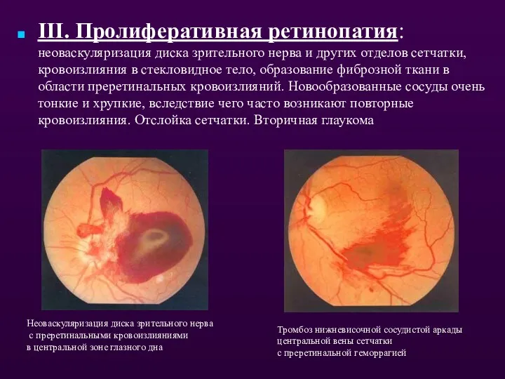 III. Пролиферативная ретинопатия: неоваскуляризация диска зрительного нерва и других отделов