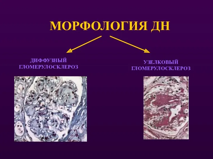 МОРФОЛОГИЯ ДН ДИФФУЗНЫЙ ГЛОМЕРУЛОСКЛЕРОЗ УЗЕЛКОВЫЙ ГЛОМЕРУЛОСКЛЕРОЗ